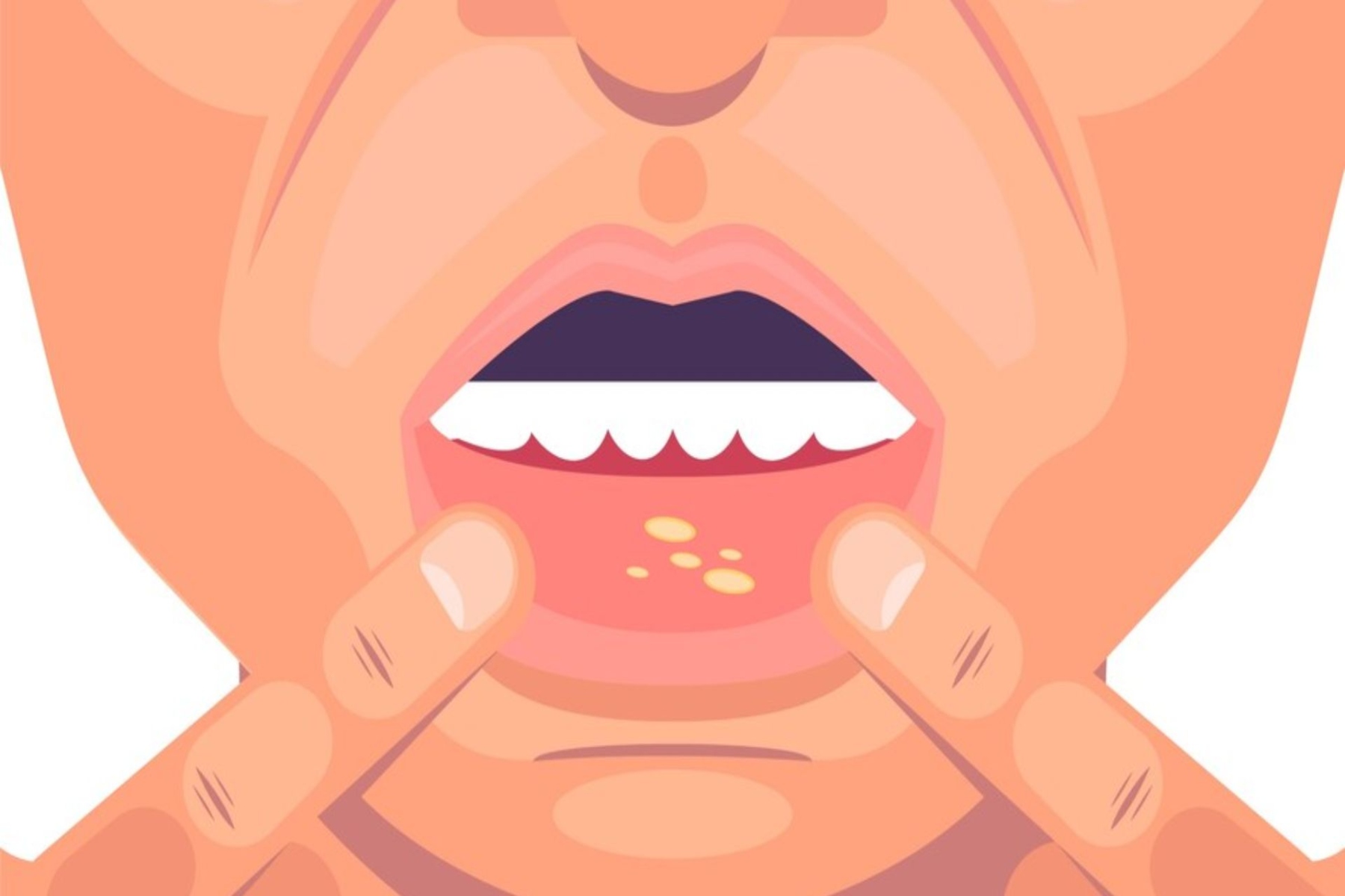 Στοματικό έλκος: Ξεκλειδώστε τα μυστικά για την αποτελεσματική θεραπεία του στοματικού έλκους