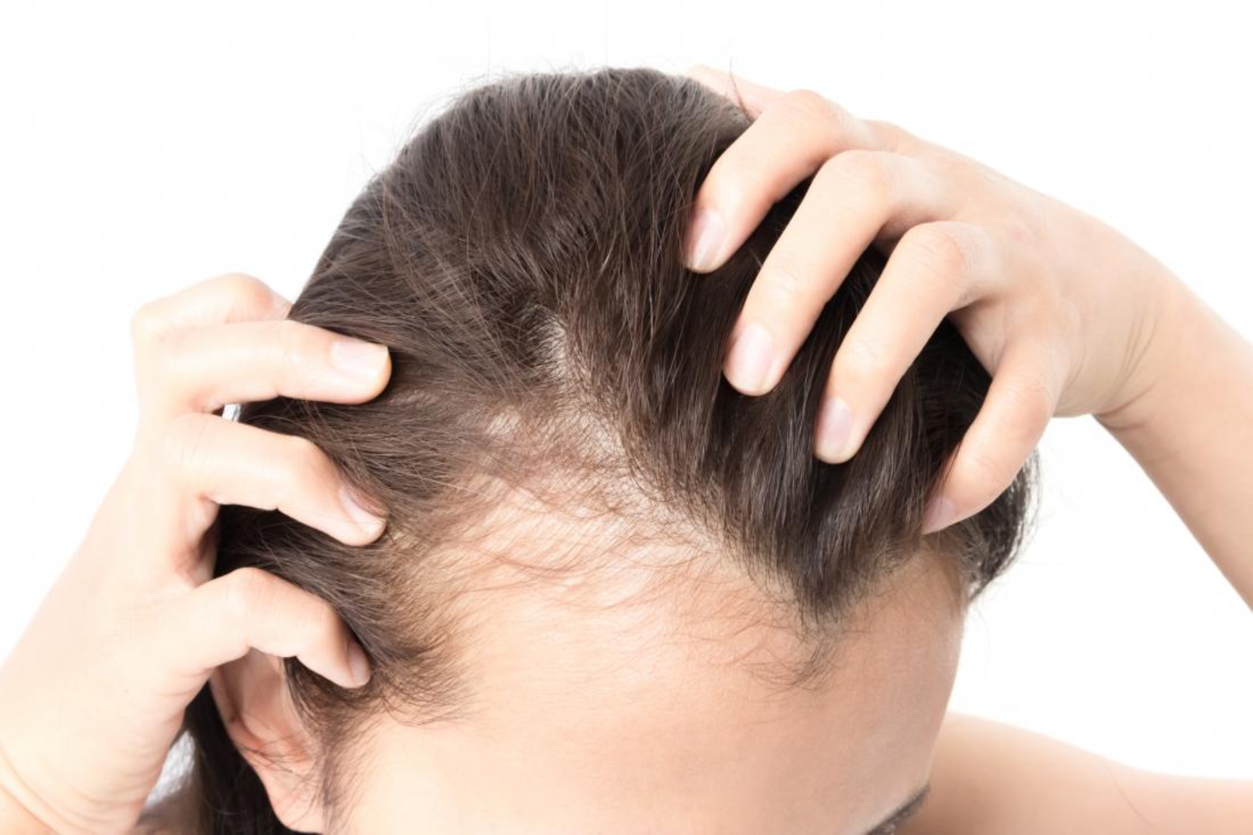 Τριχόπτωση λιπαντικά: Χρησιμοποιώντας έλαια για να σταματήσει η απώλεια μαλλιών
