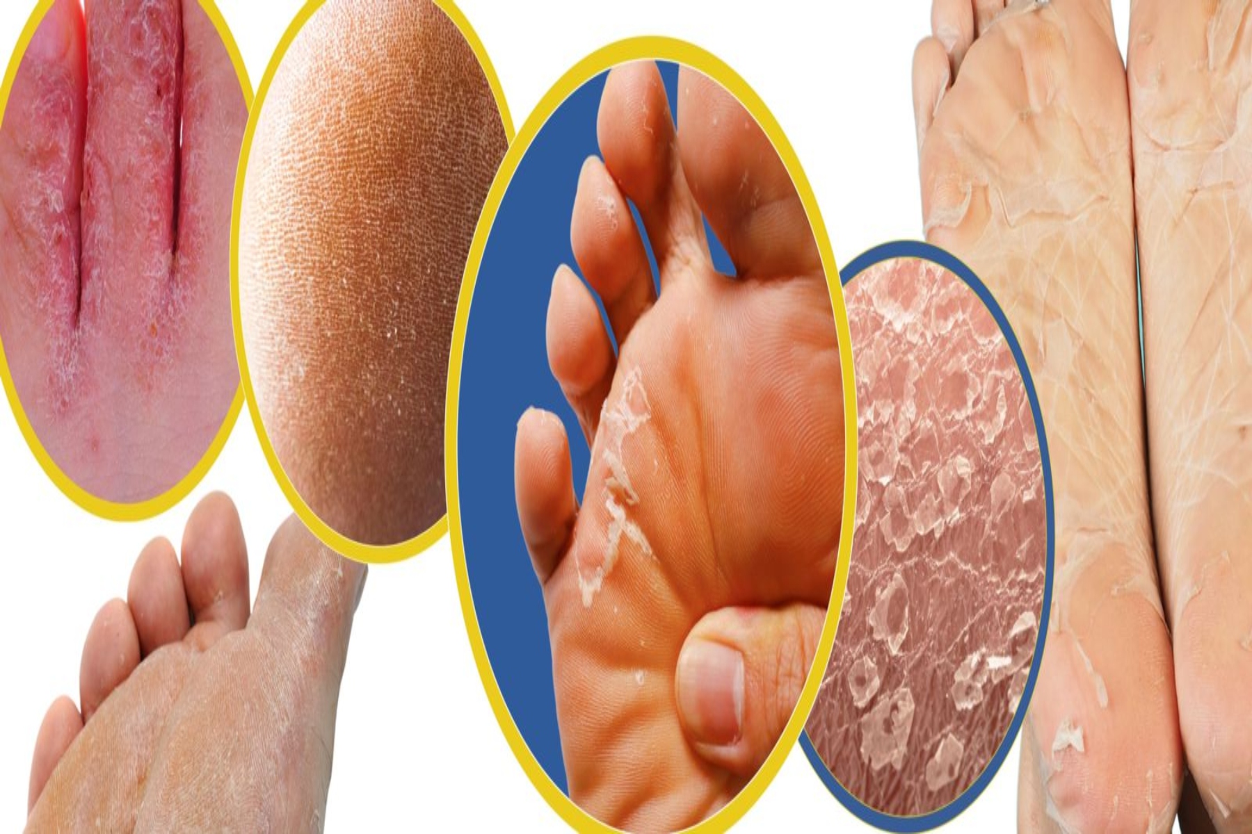 Δέρμα ξεφλούδισμα: Λόγοι για τους οποίους τα πόδια μας μπορεί να ξεφλουδίζουν