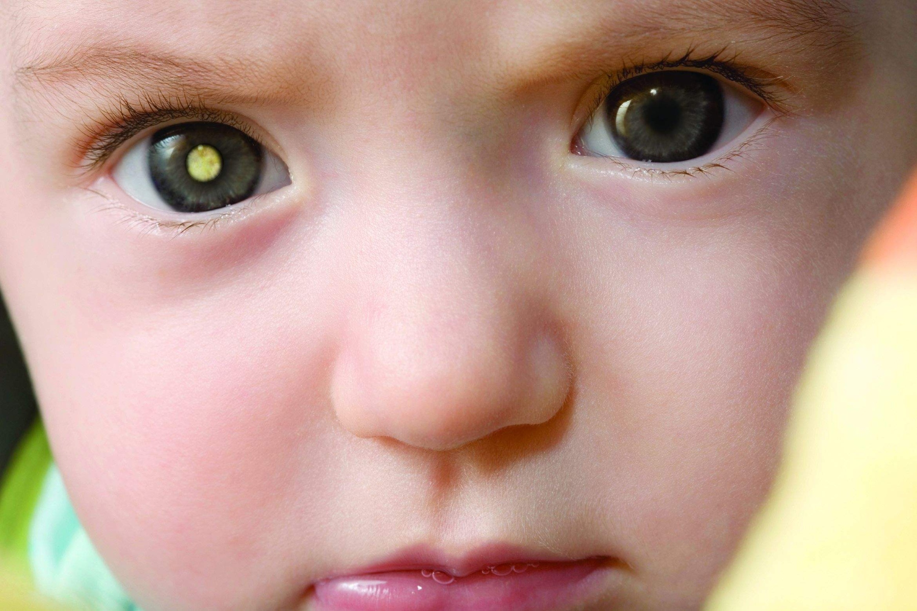 Μάτια καρκίνος: Τι πρέπει να γνωρίζουμε για τον παιδικό καρκίνο ματιών;