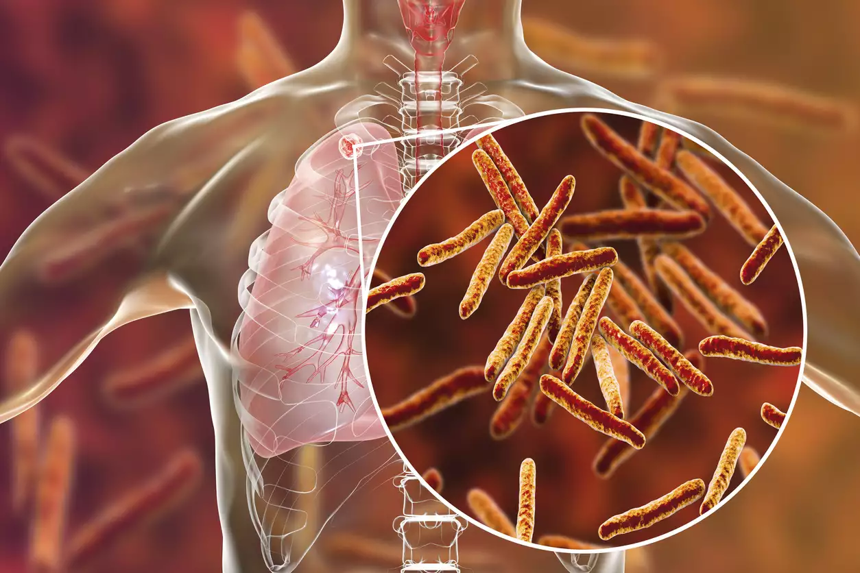 Φυματίωση: Συσχέτιση μεταξύ της λοίμωξης και του αυξημένου κινδύνου για διάφορους καρκίνους