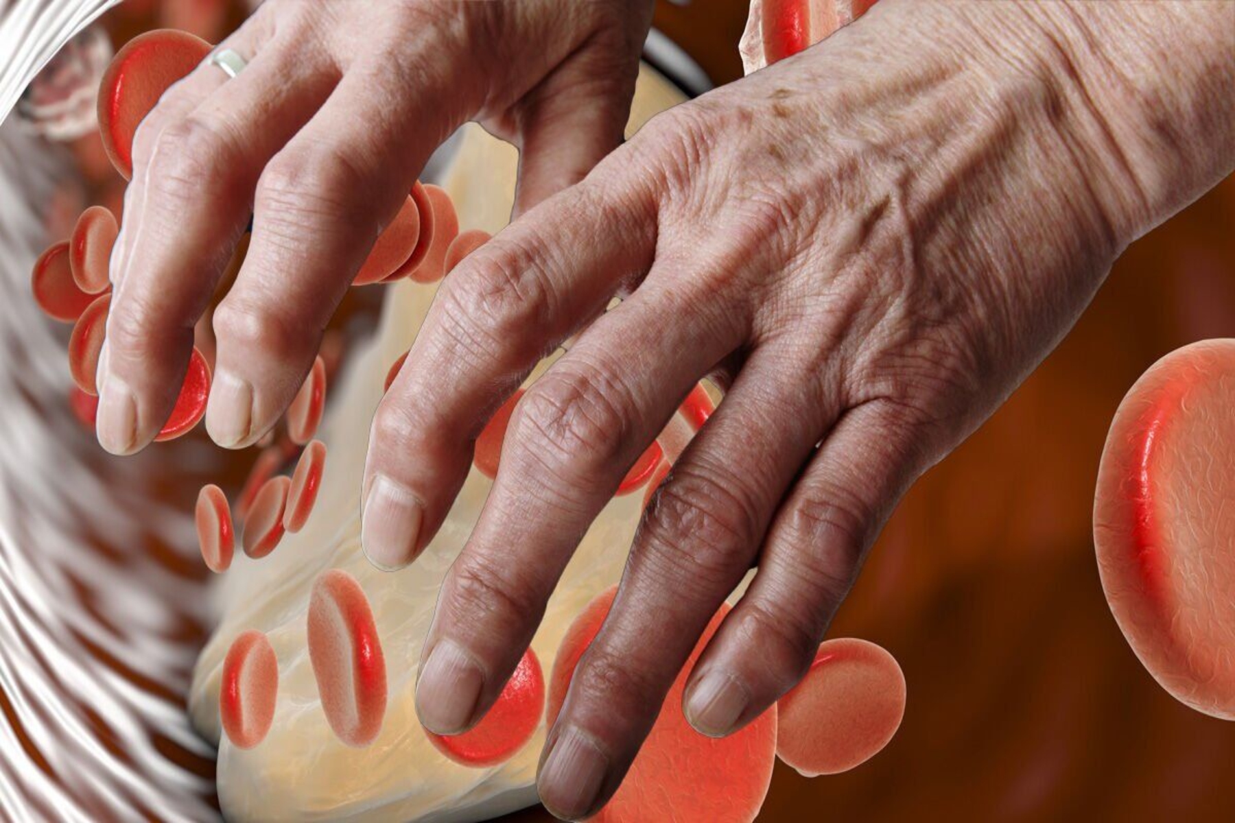 Υψηλή χοληστερίνη: Ασυνήθιστα σημάδια υψηλών επιπέδων χοληστερόλης στα χέρια και στα δάχτυλα