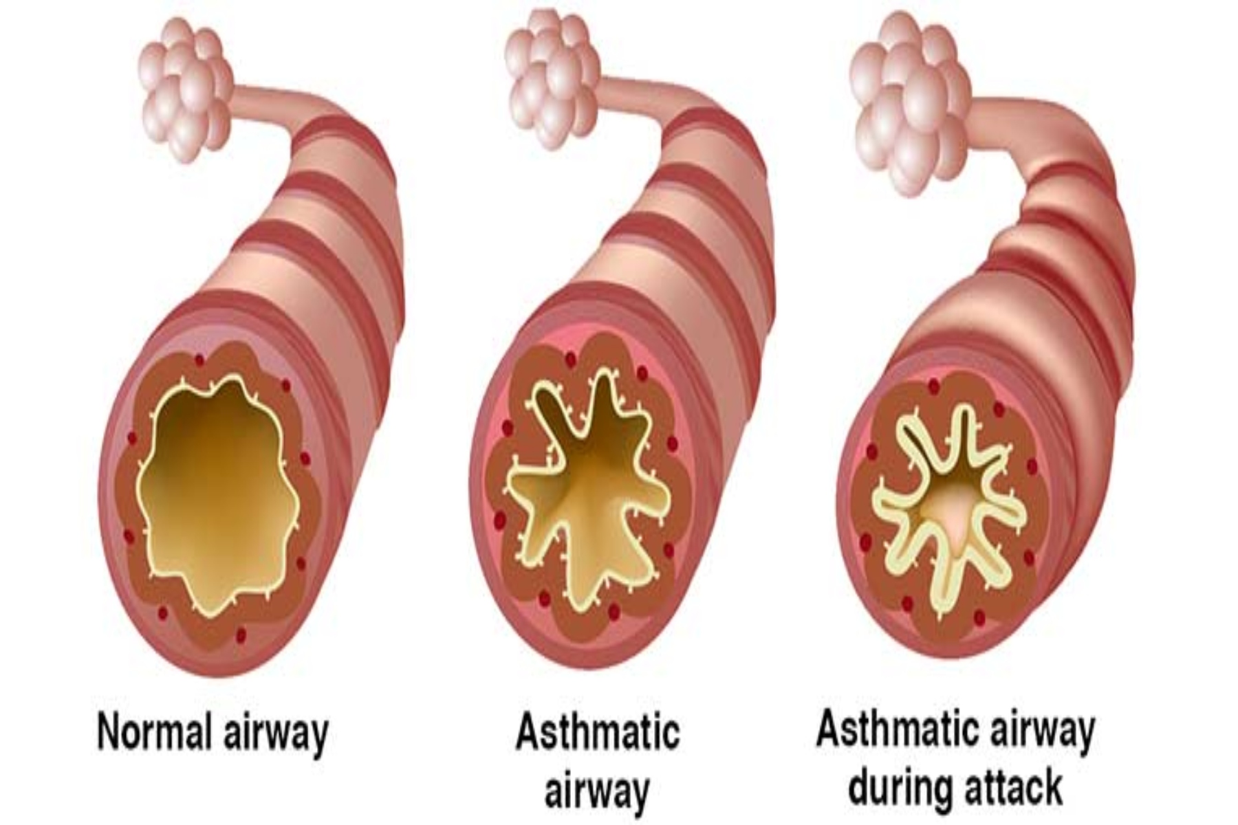 Άσθμα: Μύθοι και αλήθειες γύρω από το άσθμα