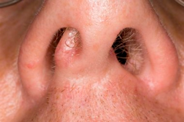 Όγκος μύτη: Πόσο σπάνια ή όχι εμφανίζεται όγκος στη μύτη;