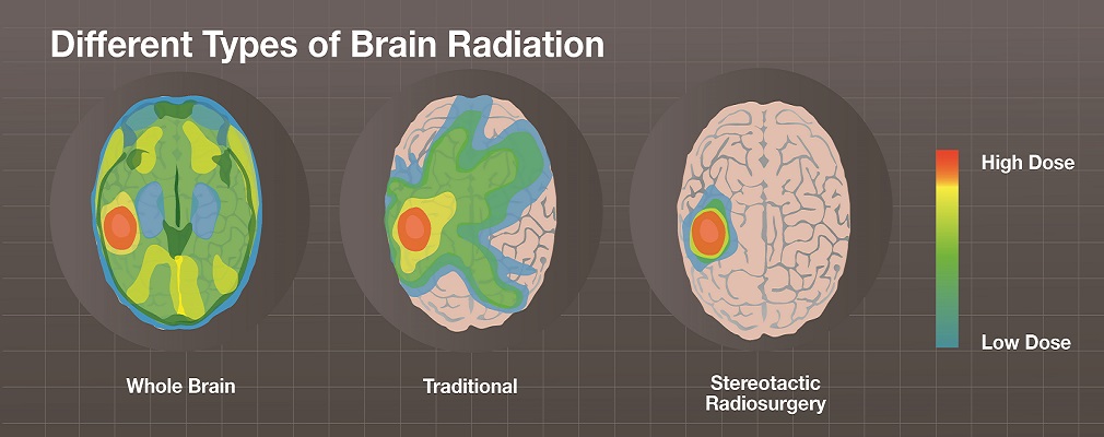Όγκοι του Εγκεφάλου: Χρήση ακτινοθεραπείας για την καταστροφή τους