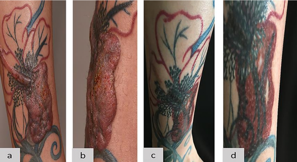Αποκαλύφθηκε πιθανή συσχέτιση μεταξύ τατουάζ και λεμφώματος