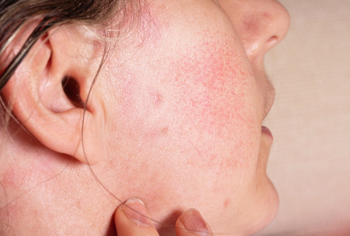 how to get rid of redness on face feat 1