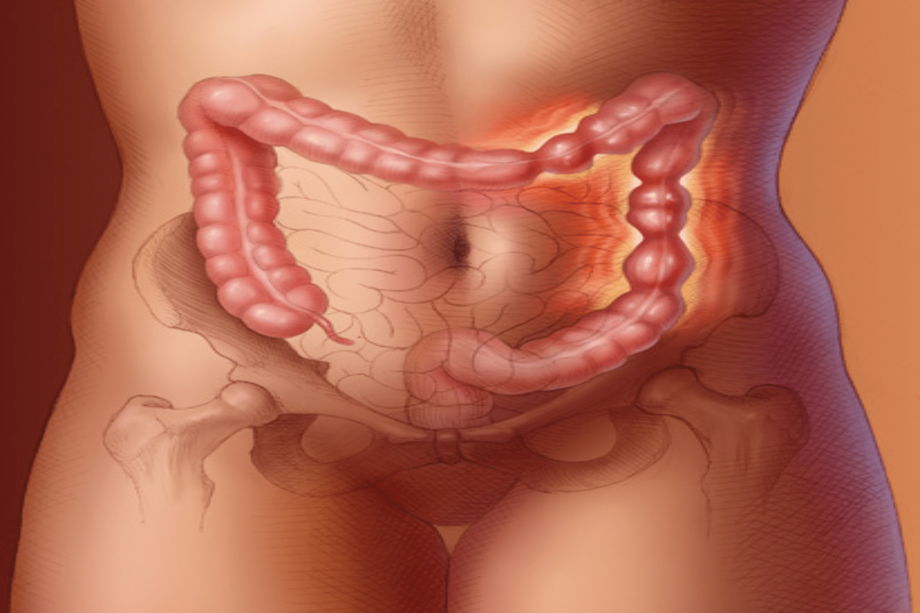 ibs 1