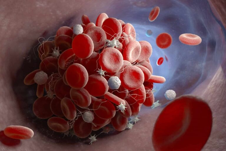Θρόμβωση: 7 σημάδια SOS που πρέπει να γνωρίζετε